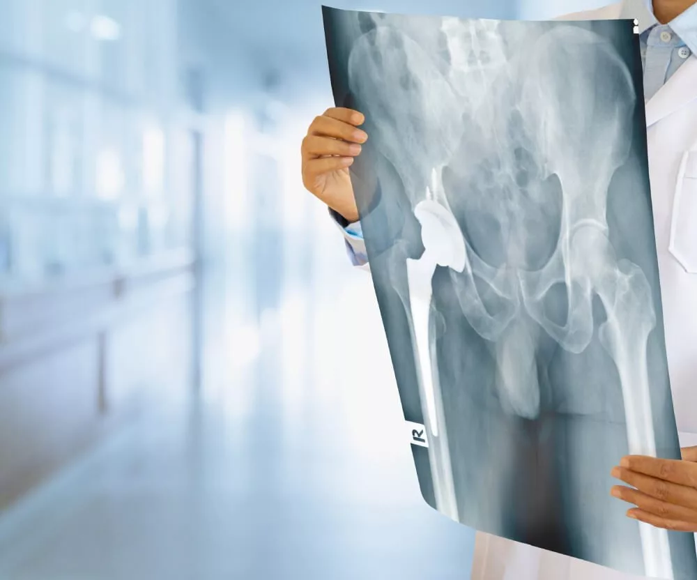Hip Replacement