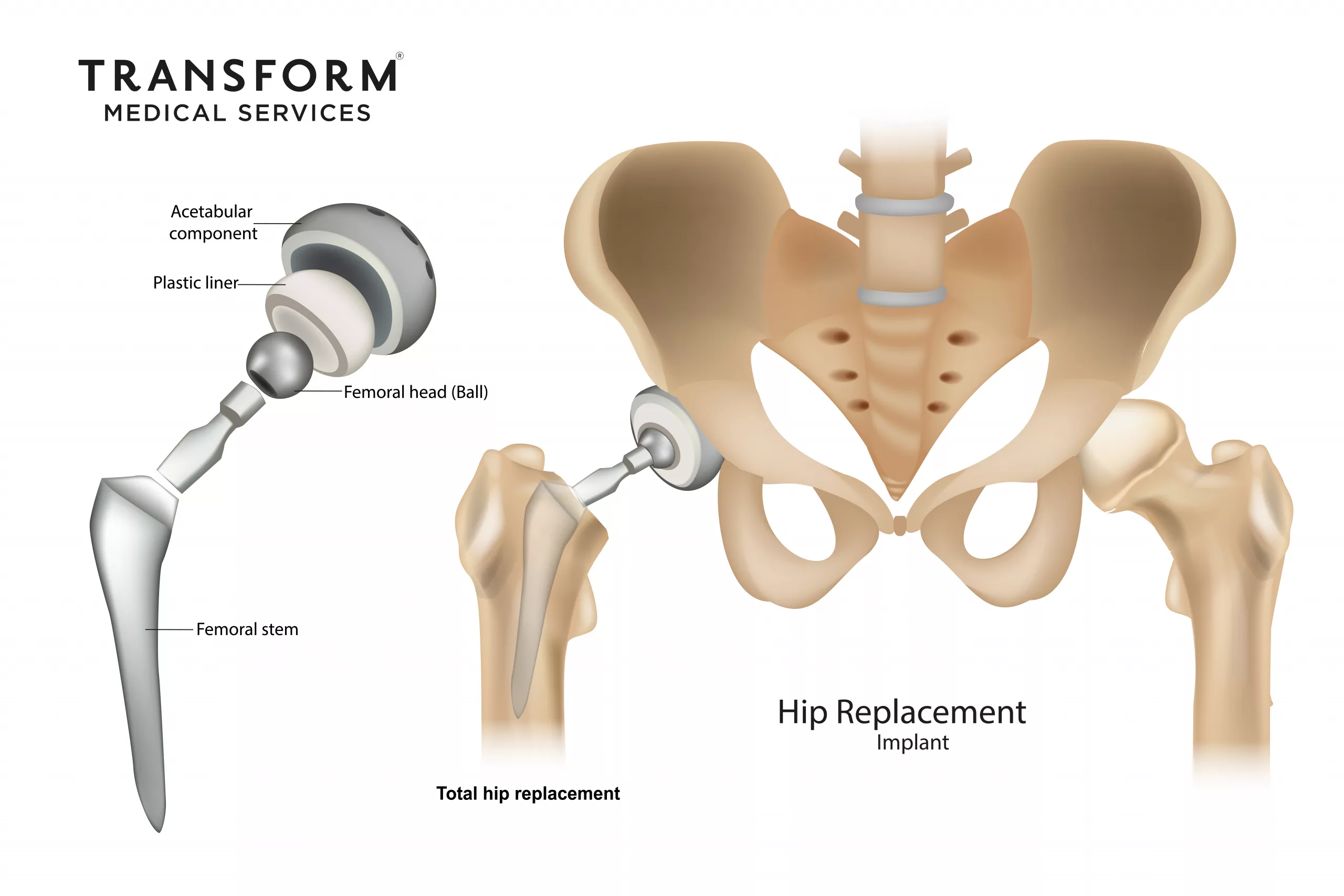 https://cos.transforminglives.co.uk/wp-content/uploads/2025/04/HipReplacement_image-01-scaled.webp