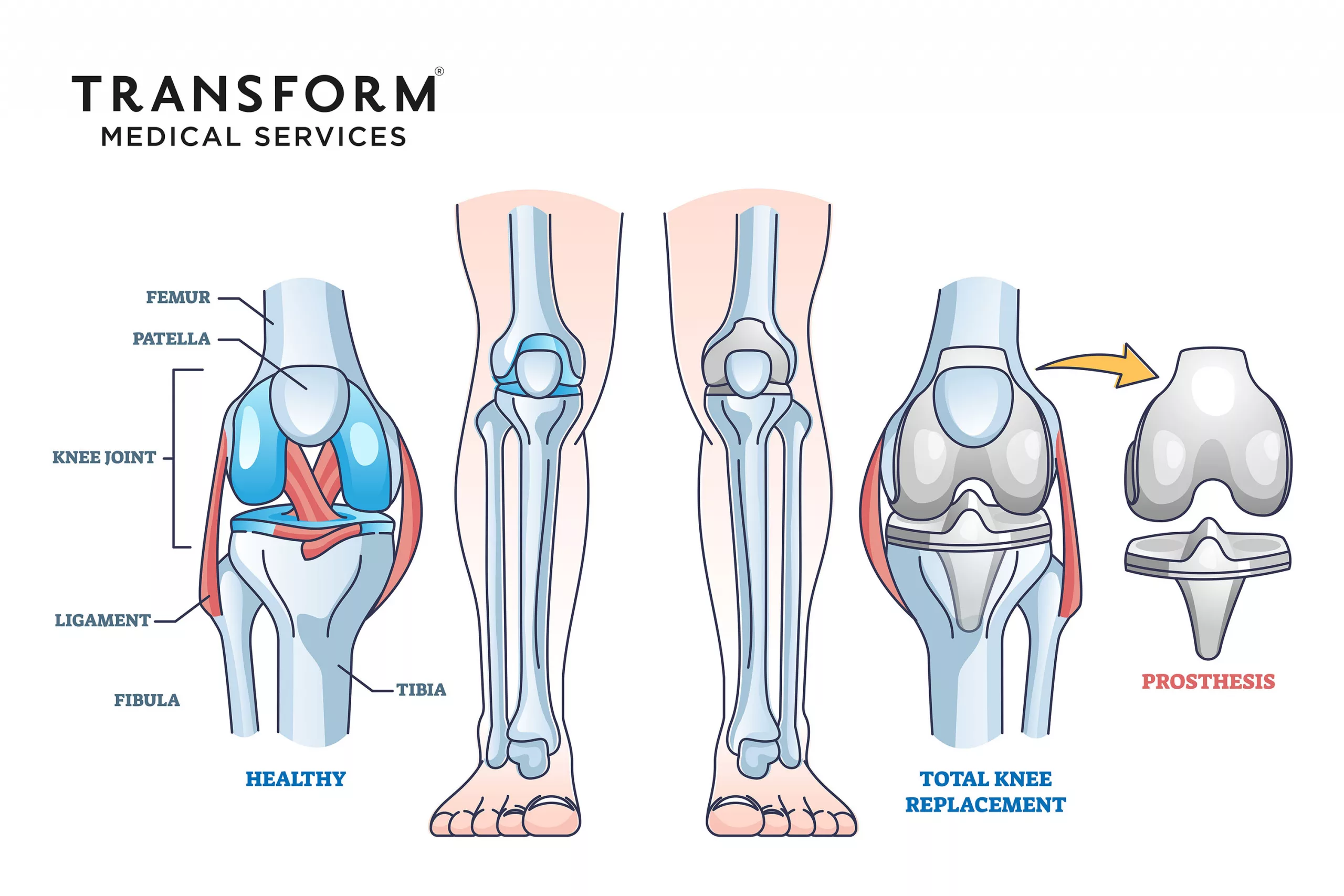Total knee replacement surgery and prosthesis operation outline diagram. Labeled educational medical procedure description with healthy orthopedic anatomical bone structure scheme vector illustration.